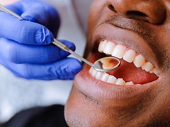Man receiving dental examination after tooth colored filling placement