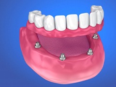 implant denture being supported by four dental implants in Torrance