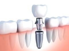 Illustration of implant, abutment, and crown next to natural teeth