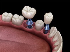 two dental implants with crowns