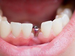 close-up of a dental implant with an abutment in someone’s mouth