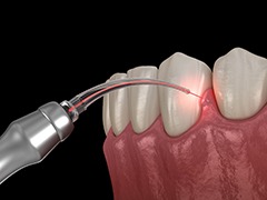 Gums being treated with soft tissue laser in Torrance, CA