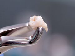 An extracted tooth