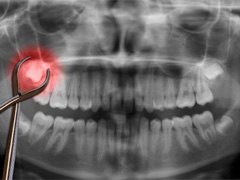 A dental X-ray showing a wisdom tooth that needs removal 