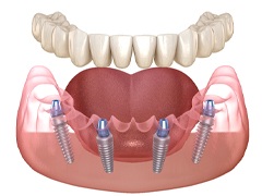 Animated all-on-4 dental implants