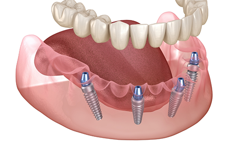 Illustration of All on 4 dental implants being placed in the lower arch