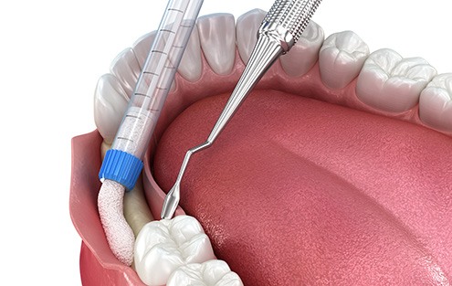 a 3D illustration demonstrating the bone grafting process 
