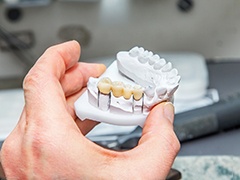 Dental bridge on clay model