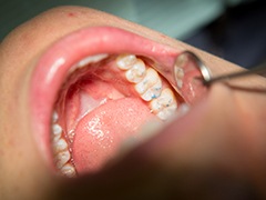 Closeup of teeth after metal free dental restoration placement