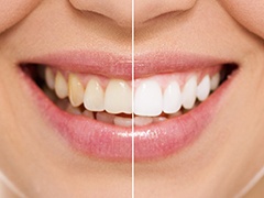 Closeup of smile half before and half after whitening