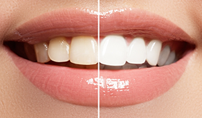 Close up of a smile before and after whitening the teeth
