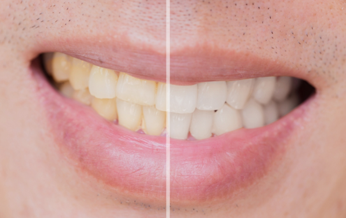 CLose up of a smile before and after teeth whitening