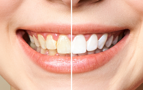 Close up of teeth before and after whitening