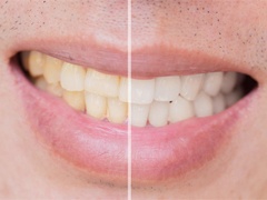 A before and after image of a person’s smile after undergoing teeth whitening