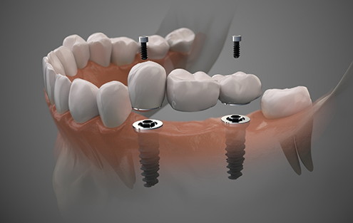 Illustration of a dental bridge supported by two dental implants