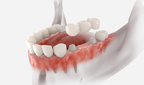Model of a traditional dental bridge
