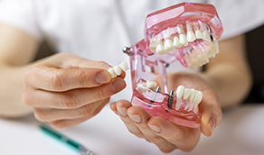Dentist holding a model of a dental implant bridge