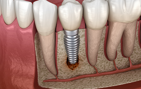 Illustration of a failed dental implant in the jawbone