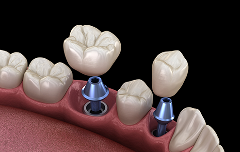 Illustration of two dental crowns being placed onto two dental implants