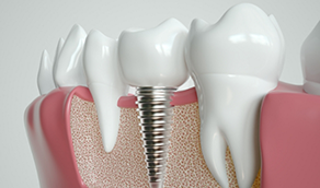 Illustration of a crown on a dental implant in the lower arch