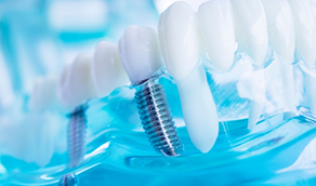 Model of a dental bridge supported by two dental implants