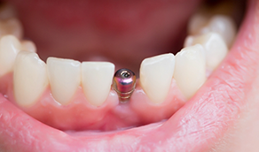 Close up of a person smiling with a visible dental implant abutment