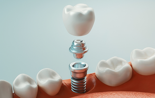Illustration of a dental implant with an abutment and crown being placed in the lower jaw