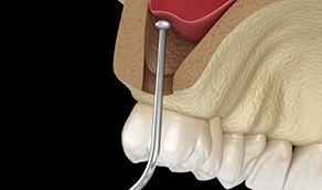 Illustrated instrument lifting up the sinus