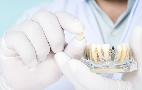 Dentist holding a dental crown and a model of a mouth with a dental implant
