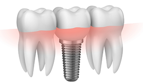 Illustration of dental implant between two natural teeth