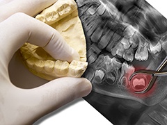 X-ray and smile model with tooth to be extracted