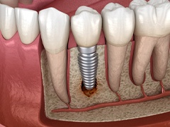 A digital image of a dental implant failure in Torrance