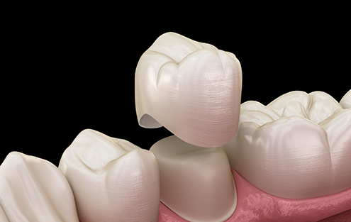 Illustration of dental crown being fitted over a tooth