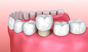 Illustrated tooth being fitted with a dental crown