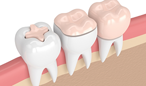 Three illustrated teeth with differently sized inlays and onlays