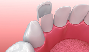 Illustrated veneer being placed over the front of a tooth