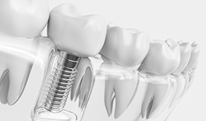 Illustrated dental implant replacing a missing lower tooth