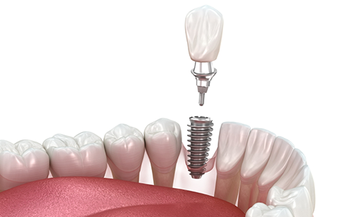 Illustration dental implant being placed in the lower arch