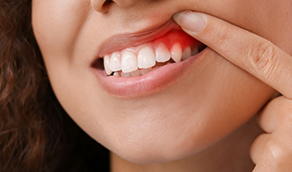 Woman pointing to red spot in her upper gums