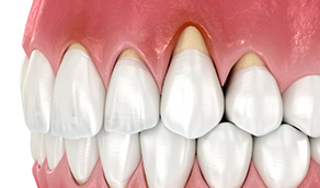 Illustrated mouth with recession in the upper gums