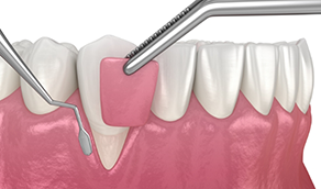 Illustration of gum graft being placed over an area with receding gum tissue