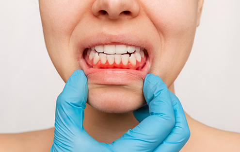 Person pulling down their lower lip to reveal red gums