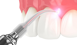 Illustration of dental laser performing crown lengthening