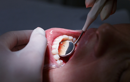 Periodontist examining a patients gums with a dental mirror