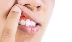 Close up of a person pointing to their red gums