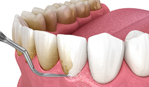 Illustrated dental scaler clearing plaque buildup from the gumline