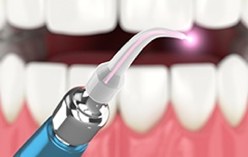 Illustration of a soft tissue laser in front of a smile