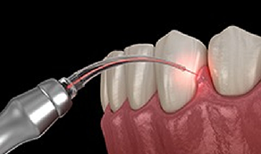 Illustrated laser treating the gums