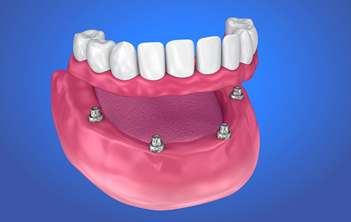 Illustration of an implant denture on the lower arch of teeth