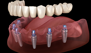 Illustrated denture being placed onto six dental implants